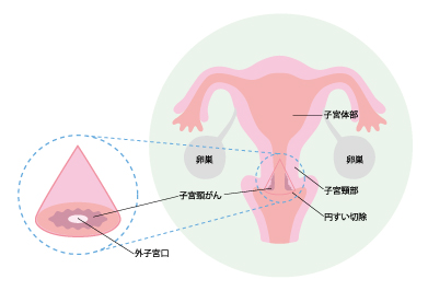 早期発見 早期発見