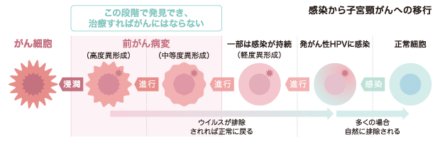 感染から子宮頸がんへの移行